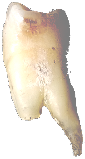 tand buitenkant