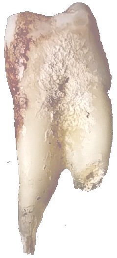 tand binnenkant